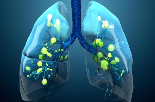 Pourquoi les infections pulmonaires entraînent des séquelles à long terme ?