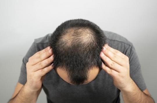 Covid-19 : les hommes chauves seraient plus à risque