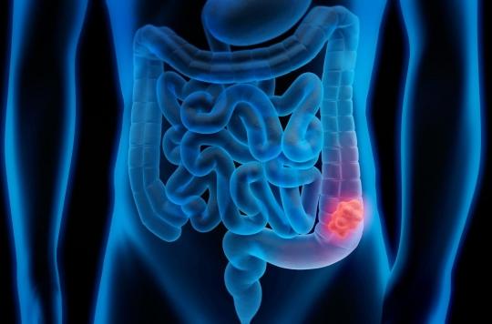 Cancer du côlon : des bactéries intestinales pourraient être un indicateur de risque