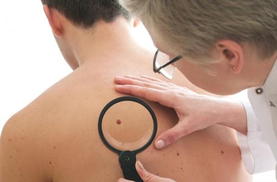 Cancer de la peau : le dépistage précoce augmente les chances de survie