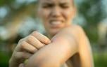 Comment apaiser la peau après les piqûres de moustiques ? 