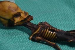Le squelette  extraterrestre d’Atacama? Une petite fille au corps déformé par une maladie génétique...