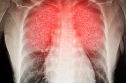 Covid-19: d’où viennent les lésions pulmonaires dont souffrent certains malades?
