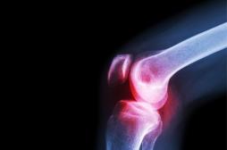 Arthrose du genou : l’hydrogel fait ses preuves pour remplacer le cartilage
