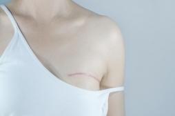 Cancer du sein métastatique : la chirurgie augmente les chances de survie