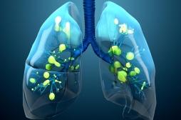 Pourquoi les infections pulmonaires entraînent des séquelles à long terme ?