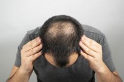 Covid-19 : les hommes chauves seraient plus à risque