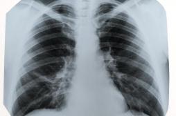 Une femme développe un cancer du poumon après le don d'organe d'une grosse fumeuse