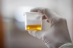 Cancer de la prostate : le taux de spermine dans l’urine permet d'évaluer le risque 