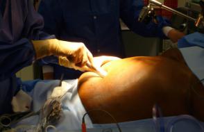 Chirurgie bariatrique : 500 000 opérés d'ici 5 ans