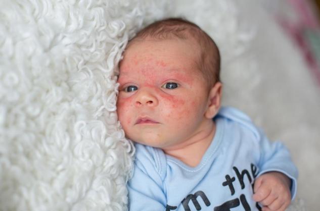 Eczéma du nourrisson : une dermatite atopique qui va régresser