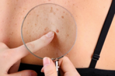 Mélanome : un cancer de la peau lié principalement au soleil